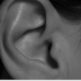L’otoplastie : tout savoir sur la chirurgie des oreilles décollées